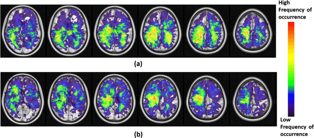 Figure 3 for Can tumor location on pre-treatment MRI predict likelihood of pseudo-progression versus tumor recurrence in Glioblastoma? A feasibility study