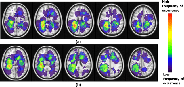 Figure 4 for Can tumor location on pre-treatment MRI predict likelihood of pseudo-progression versus tumor recurrence in Glioblastoma? A feasibility study