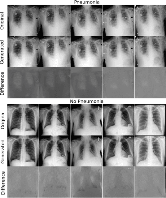 Figure 1 for GANs 'N Lungs: improving pneumonia prediction