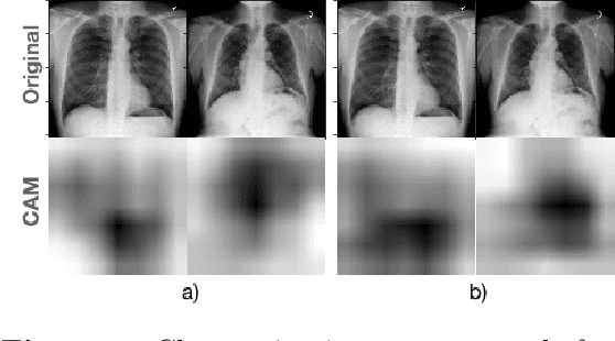 Figure 2 for GANs 'N Lungs: improving pneumonia prediction