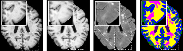 Figure 1 for Superpixel-Guided Label Softening for Medical Image Segmentation