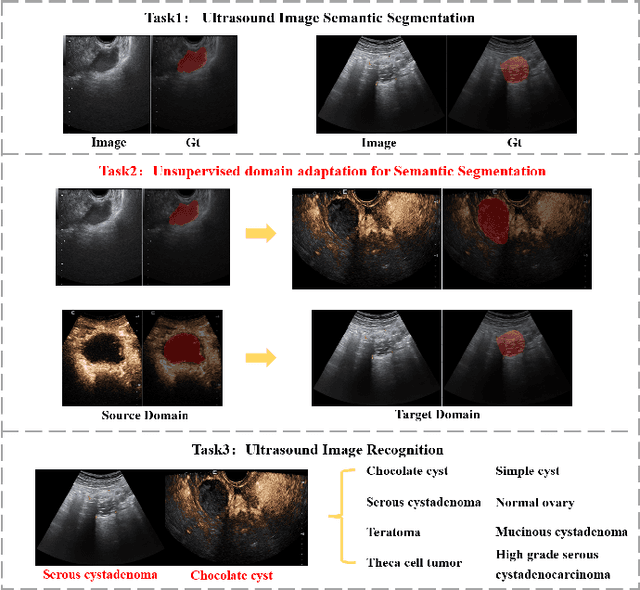 Figure 1 for A Multi-Modality Ovarian Tumor Ultrasound Image Dataset for Unsupervised Cross-Domain Semantic Segmentation