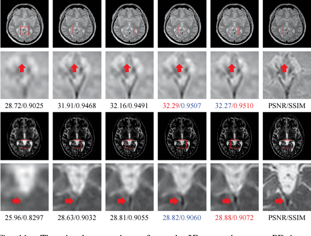 Figure 3 for Single MR Image Super-Resolution via Channel Splitting and Serial Fusion Network
