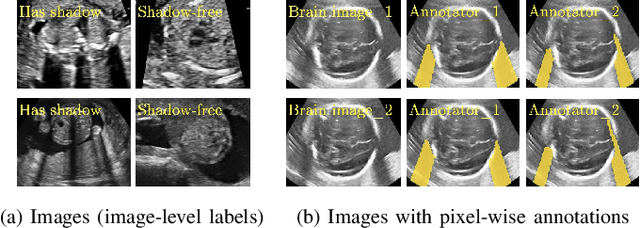 Figure 1 for Weakly Supervised Estimation of Shadow Confidence Maps in Ultrasound Imaging