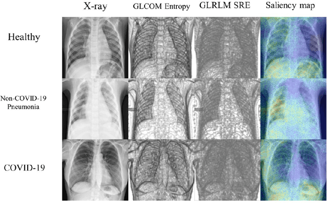 Figure 4 for A Radiomics-Boosted Deep-Learning Model for COVID-19 and Non-COVID-19 Pneumonia Detection Using Chest X-ray Image