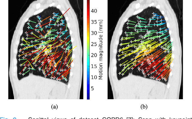 Figure 2 for Estimation of Large Motion in Lung CT by Integrating Regularized Keypoint Correspondences into Dense Deformable Registration