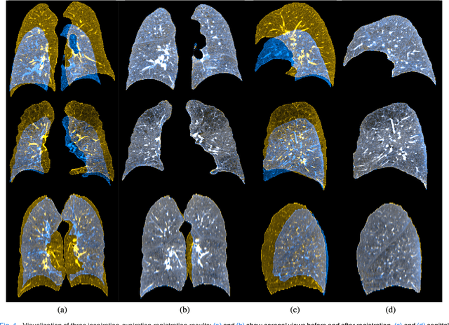 Figure 4 for Estimation of Large Motion in Lung CT by Integrating Regularized Keypoint Correspondences into Dense Deformable Registration