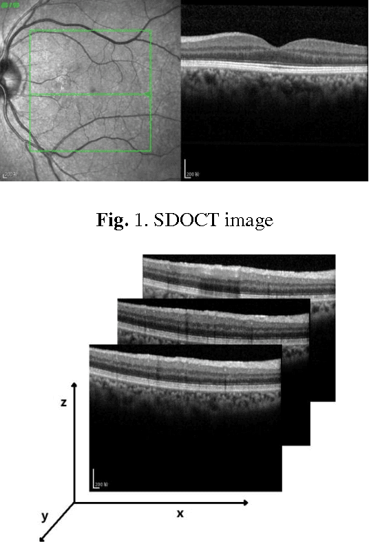 Figure 1 for 3D Automatic Segmentation Method for Retinal Optical Coherence Tomography Volume Data Using Boundary Surface Enhancement