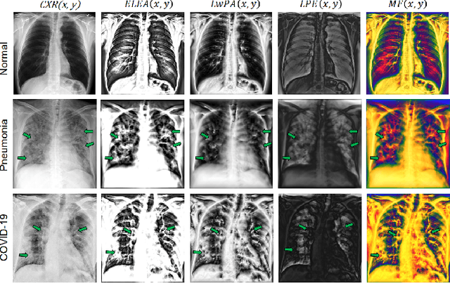 Figure 1 for Multi-Feature Semi-Supervised Learning for COVID-19 Diagnosis from Chest X-ray Images