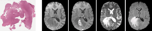 Figure 2 for Multimodal brain tumor classification