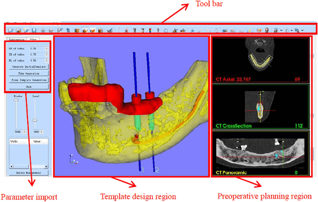 Figure 3 for A semi-automatic computer-aided method for surgical template design