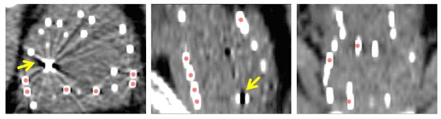 Figure 1 for A Deep Regression Model for Seed Identification in Prostate Brachytherapy