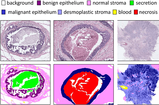 Figure 1 for Learning to Segment Breast Biopsy Whole Slide Images