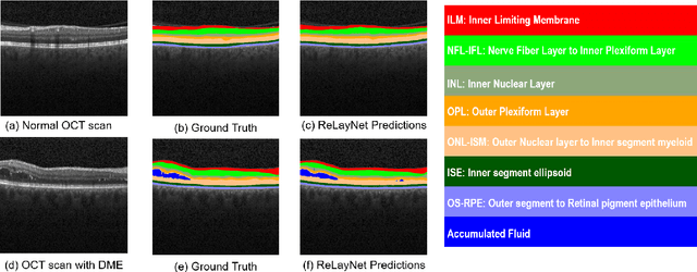 Figure 1 for ReLayNet: Retinal Layer and Fluid Segmentation of Macular Optical Coherence Tomography using Fully Convolutional Network