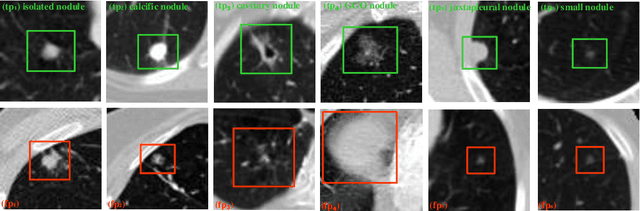 Figure 1 for Two-Stage Convolutional Neural Network Architecture for Lung Nodule Detection