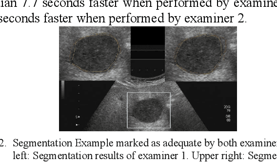 Figure 2 for In-depth Assessment of an Interactive Graph-based Approach for the Segmentation for Pancreatic Metastasis in Ultrasound Acquisitions of the Liver with two Specialists in Internal Medicine