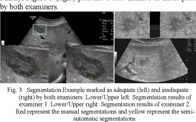 Figure 3 for In-depth Assessment of an Interactive Graph-based Approach for the Segmentation for Pancreatic Metastasis in Ultrasound Acquisitions of the Liver with two Specialists in Internal Medicine