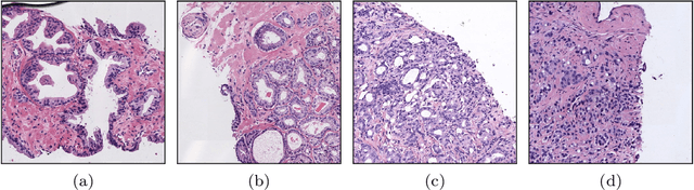 Figure 1 for WeGleNet: A Weakly-Supervised Convolutional Neural Network for the Semantic Segmentation of Gleason Grades in Prostate Histology Images