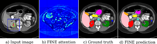 Figure 1 for Memory transformers for full context and high-resolution 3D Medical Segmentation