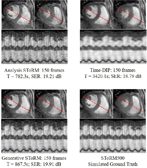 Figure 4 for Deep Generative SToRM model for dynamic imaging