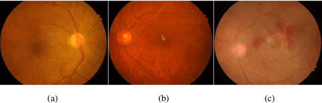 Figure 1 for Few-shot Learning Based on Multi-stage Transfer and Class-Balanced Loss for Diabetic Retinopathy Grading