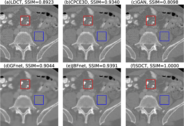 Figure 4 for JBFnet -- Low Dose CT Denoising by Trainable Joint Bilateral Filtering