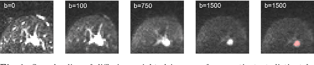 Figure 1 for Domain Adaptation for Deviating Acquisition Protocols in CNN-based Lesion Classification on Diffusion-Weighted MR Images