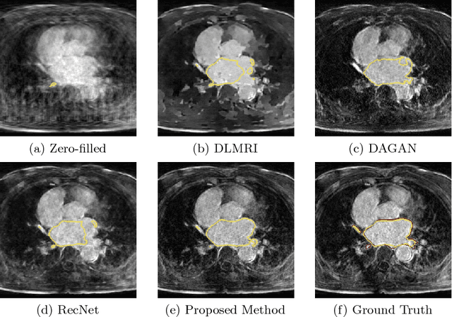 Figure 3 for Adversarial and Perceptual Refinement for Compressed Sensing MRI Reconstruction