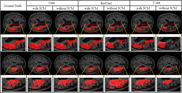 Figure 4 for Brain Stroke Lesion Segmentation Using Consistent Perception Generative Adversarial Network