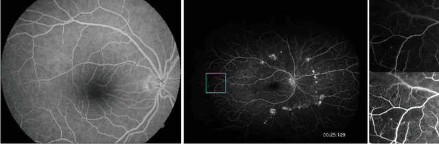 Figure 1 for A Novel Deep Learning Pipeline for Retinal Vessel Detection in Fluorescein Angiography