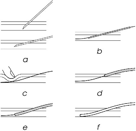 Figure 2 for Toward Robotically Automated Femoral Vascular Access