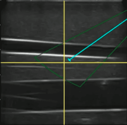 Figure 4 for Toward Robotically Automated Femoral Vascular Access