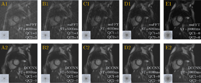 Figure 3 for Quality-aware Cine Cardiac MRI Reconstruction and Analysis from Undersampled k-space Data