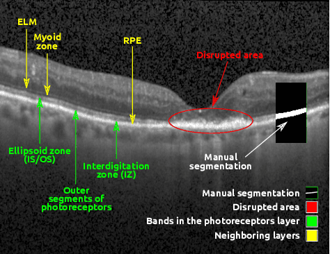 Figure 1 for U2-Net: A Bayesian U-Net model with epistemic uncertainty feedback for photoreceptor layer segmentation in pathological OCT scans