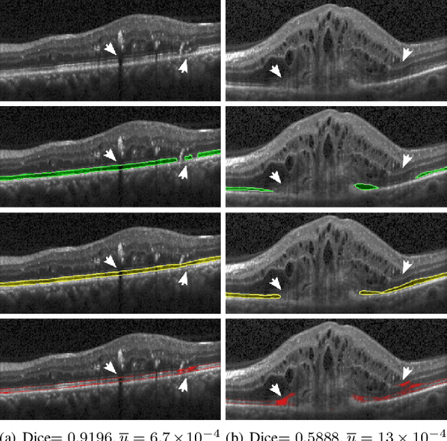 Figure 4 for U2-Net: A Bayesian U-Net model with epistemic uncertainty feedback for photoreceptor layer segmentation in pathological OCT scans