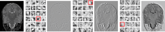 Figure 2 for Automatic segmentation of MR brain images with a convolutional neural network