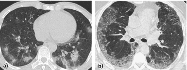 Figure 1 for A Light CNN for detecting COVID-19 from CT scans of the chest