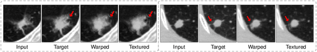 Figure 3 for Malignancy-Aware Follow-Up Volume Prediction for Lung Nodules