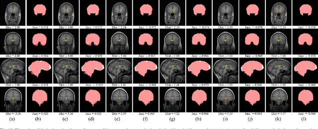 Figure 2 for Unsupervised End-to-end Learning for Deformable Medical Image Registration