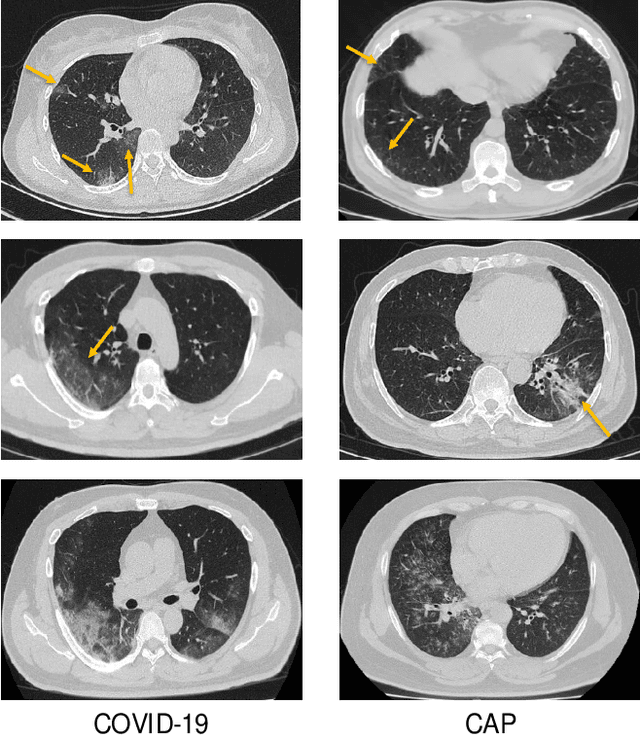 Figure 1 for Diagnosis of Coronavirus Disease 2019 (COVID-19) with Structured Latent Multi-View Representation Learning
