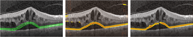 Figure 4 for An amplified-target loss approach for photoreceptor layer segmentation in pathological OCT scans