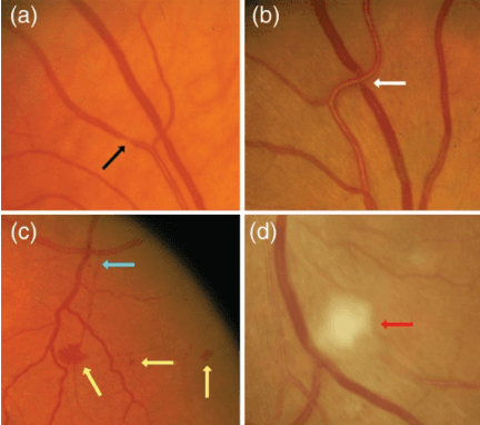 Figure 1 for PVBM: A Python Vasculature Biomarker Toolbox Based On Retinal Blood Vessel Segmentation