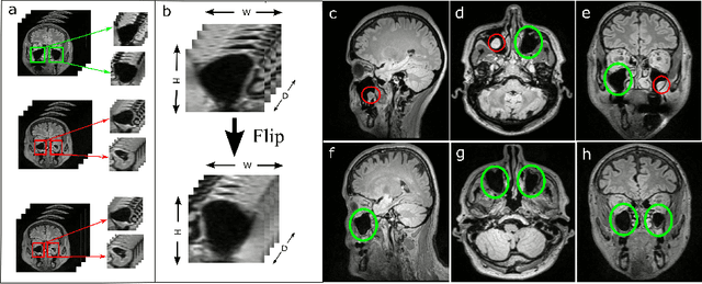 Figure 3 for Supervised Contrastive Learning to Classify Paranasal Anomalies in the Maxillary Sinus