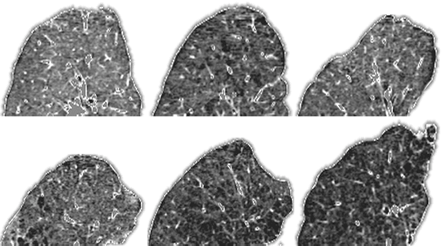 Figure 1 for Feature learning based on visual similarity triplets in medical image analysis: A case study of emphysema in chest CT scans