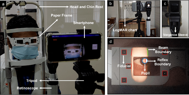 Figure 1 for Towards Automating Retinoscopy for Refractive Error Diagnosis