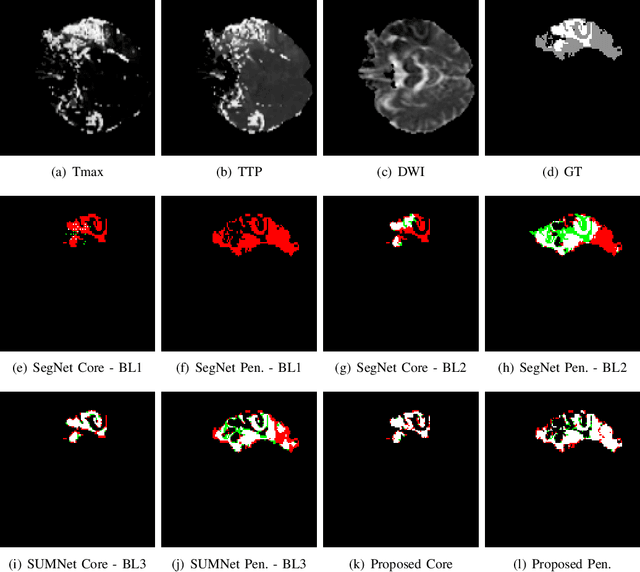 Figure 3 for Adversarially Trained Convolutional Neural Networks for Semantic Segmentation of Ischaemic Stroke Lesion using Multisequence Magnetic Resonance Imaging