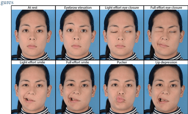 Figure 1 for Toward an Automatic System for Computer-Aided Assessment in Facial Palsy