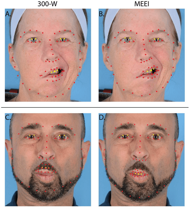 Figure 4 for Toward an Automatic System for Computer-Aided Assessment in Facial Palsy
