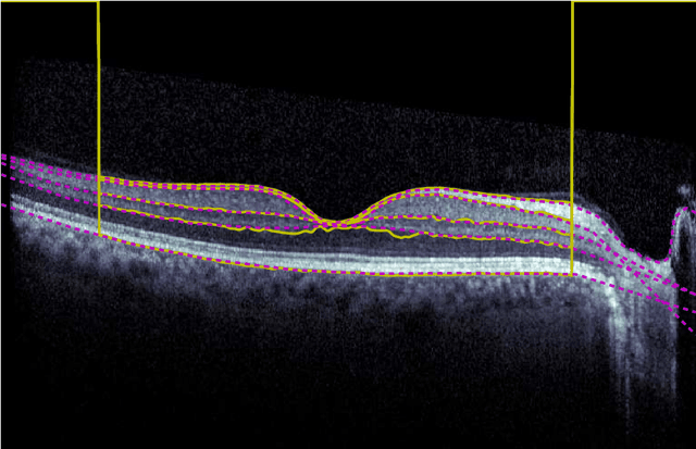 Figure 1 for Deep Learning based Retinal OCT Segmentation