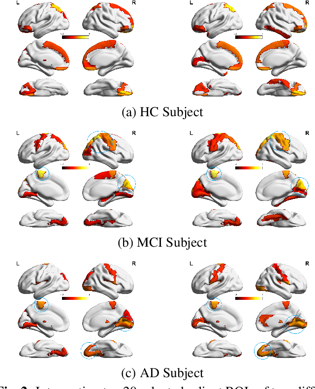 Figure 1 for Interpretable Graph Convolutional Network of Multi-Modality Brain Imaging for Alzheimer's Disease Diagnosis
